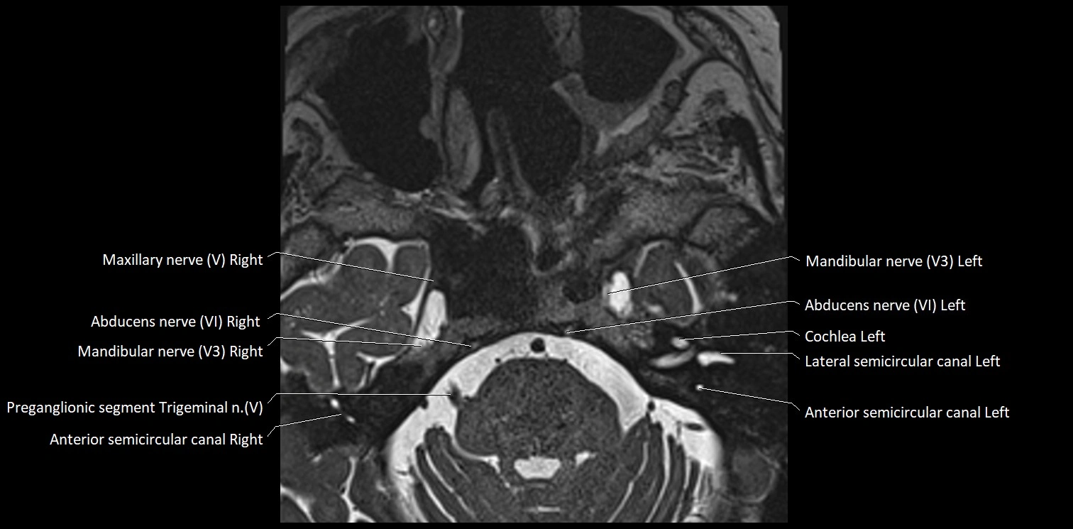 Cranial nerve anatomy axial MRI 3T image 46.webp